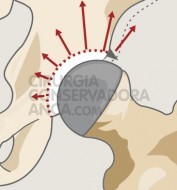 displasia-anca-fig.1-3