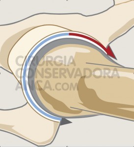 conflito-femuro-acetabular-que-Ã©-fig.1