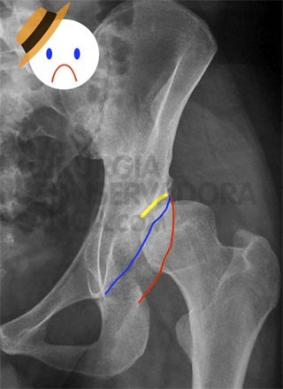 displasia-anca-fig.2-2