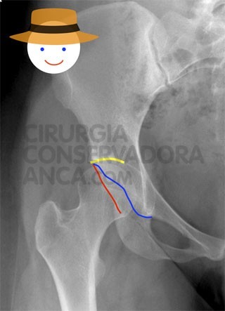 displasia-anca-fig.2-1