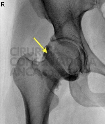 fig.4-conflito-femoro-acetabular-paulo-rego