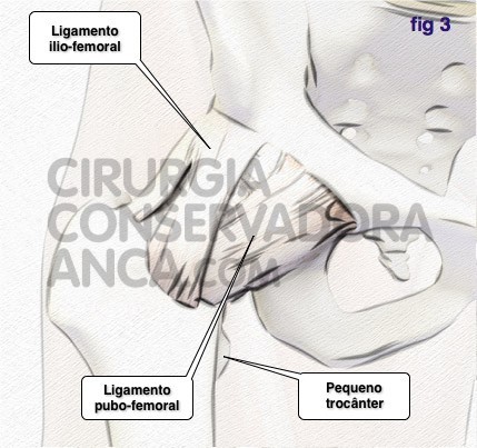 cirurgiaconservadoraanca anca norma fig.3