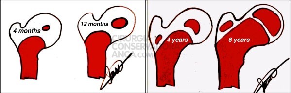 Desenvolvimento progressivo dos nÃºcleos de ossificaÃ§Ã£o do fÃ©mur proximal desde os 4 meses atÃ© aos 6 anos