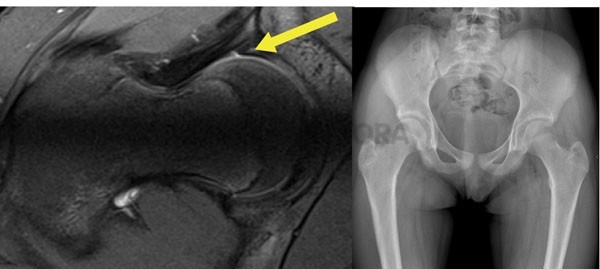 Fig.1 LesÃµes por sobrecarga funcional da anca: lesÃµes intra-articulares