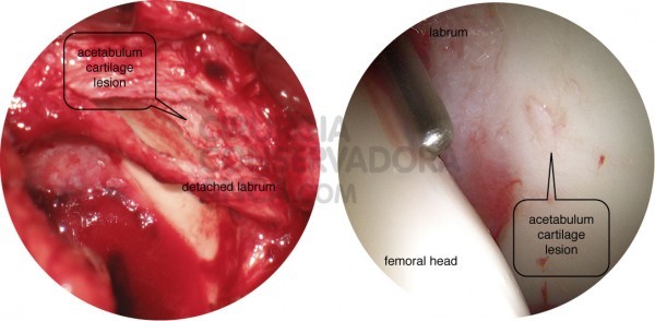 esquerda: lesÃ£o grave da cartilagem direita: visÃ£o artroscÃ³pica de uma lesÃ£o da cartilagem acetabular