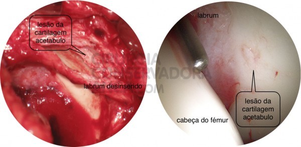 esquerda: lesÃ£o grave da cartilagem direita: visÃ£o artroscÃ³pica de uma lesÃ£o da cartilagem acetabular