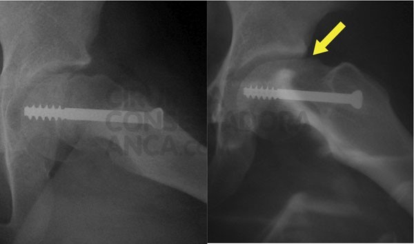 epifisiolise tratada com fixaÃ§Ã£o com uma parafuso