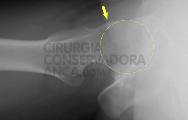 conflito-femuro-acetabular-diagnostico-fig.2