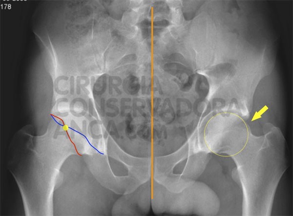 conflito-femuro-acetabular-diagnostico-fig.1