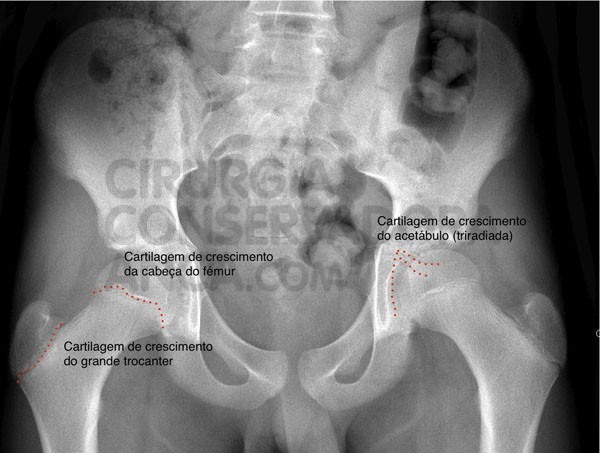 Radiografia normal de uma bacia de uma crianÃ§a com 13 anos