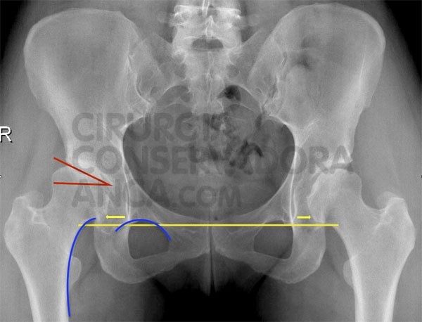 displasia-anca-soluÃ§Ã£o-fig.1