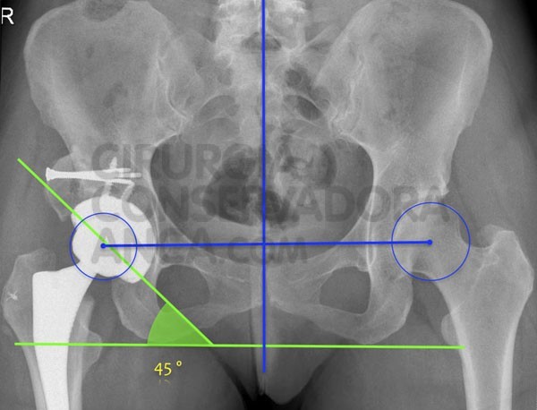 displasia-anca-soluÃ§Ã£o-fig.2