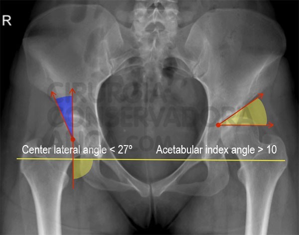 displasia-anca-diagnosticar