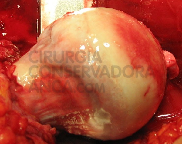 conflito-femuro-acetabular-soluÃ§Ã£o-fig.1