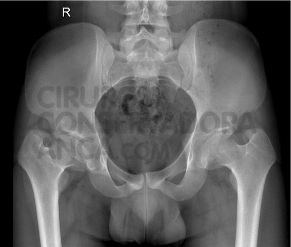 Radiografia de um doente com 22 anos e sequela de DoenÃ§a de Perthes bilaterala