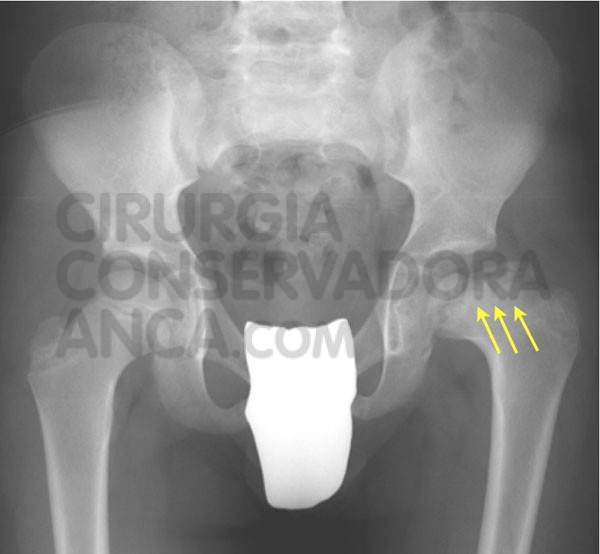 adiografia de uma crianÃ§a com 9 anos de idade com doenÃ§a de Perthes na anca esquerda