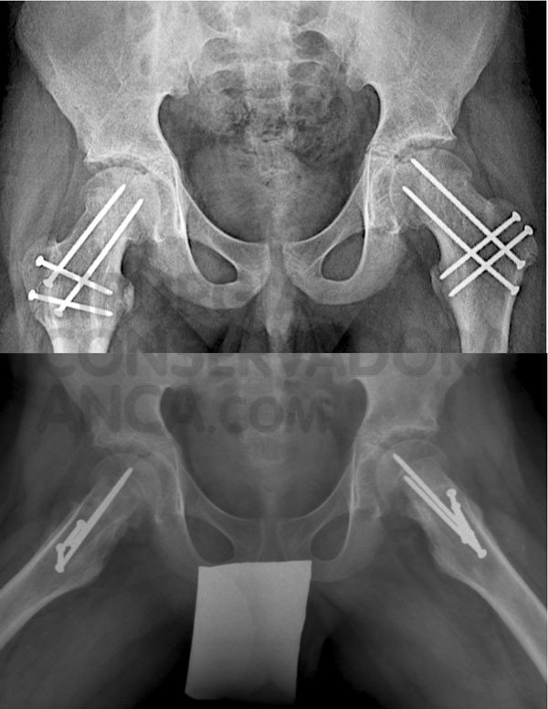 o mesmo caso da figura 4 apÃ³s reorientaÃ§Ã£o da epifise femoral.